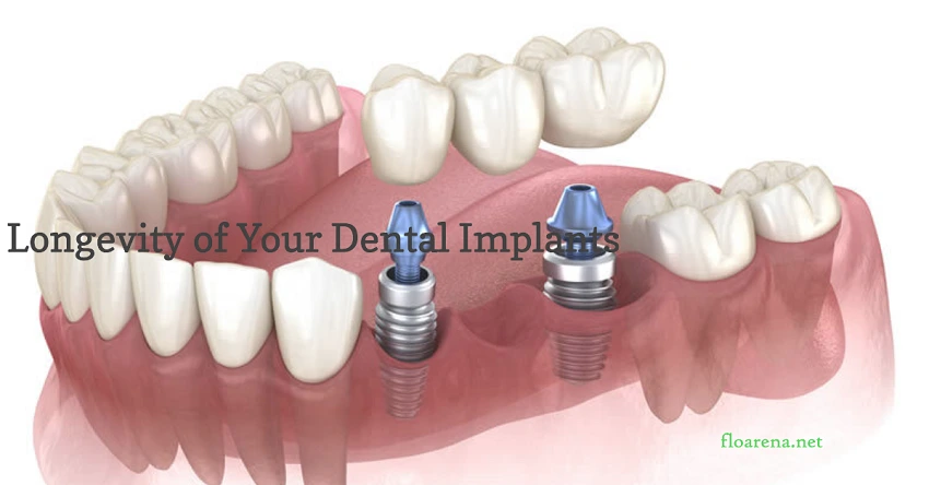 Dental Implant