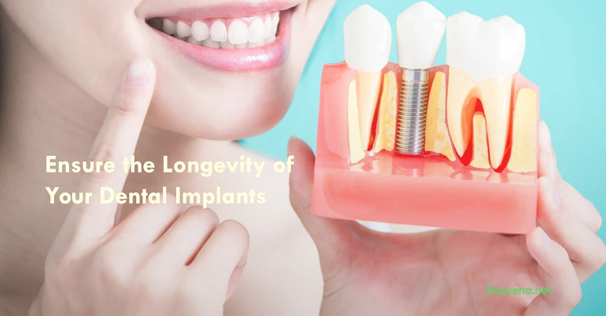 Dental Implant